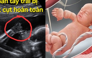 Thai nhi 21 tuần bị cắt cụt các ngón tay vì một thứ "sắc hơn dao" ngay trong bụng mẹ: Nguy hiểm nhưng khó phát