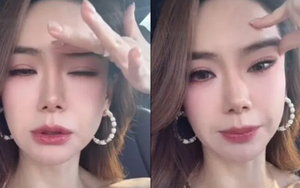 Nữ diễn viên nổi tiếng thừa nhận gương mặt "cứng đờ" vì tiêm botox quá liều, bác sĩ cảnh báo: 0,00000005 gram chất này có thể gây tử vong