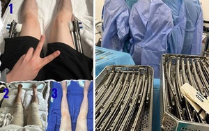 Những hình ảnh đáng sợ về thủ thuật kéo dài chân đang gây sốt toàn cầu