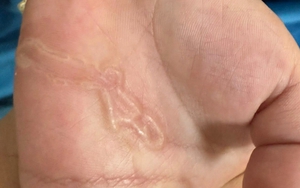 Bàn tay bé trai xuất hiện dấu hiệu lạ sau lần nghịch cát