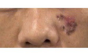 Đi nước ngoài đốt nốt ruồi, về nước phát hiện ung thư