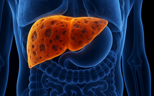 Người đàn ông bất ngờ bị suy gan cấp sau khi uống 1 thứ chỉ trong 1 tuần: Không phải rượu bia