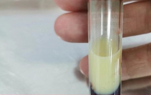 'Nhấp' vài lon bia mỗi tối, thanh niên suýt mất mạng vì mỡ máu tăng vọt