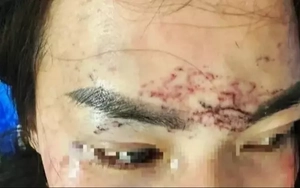 Diễn biến vụ 2 phụ nữ đánh ghen, đổ axit, xăm mặt người khác ở Cà Mau