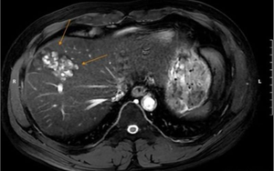 Người đàn ông 41 tuổi gan đầy ổ sán lá gan vì thói quen này của nhiều người Việt