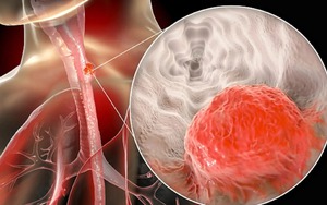 Nam giám đốc bất ngờ phát hiện ung thư giai đoạn 3: Hối hận vì đã bỏ qua 1 dấu hiệu suốt nhiều năm