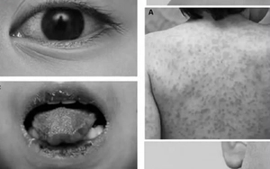 Trẻ mắc bệnh hiếm gặp gây đột tử, bác sĩ chẩn đoán bị... viêm họng