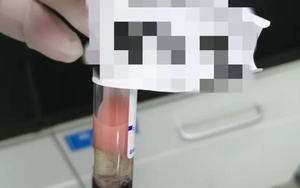 Máu biến thành “sữa dâu tây”, chàng trai 24 tuổi bị gọi gấp trở lại bệnh viện