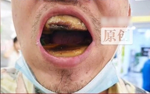 Hàm răng đáng sợ của người đàn ông tự mua nhựa về trám, nha sỹ bất lực