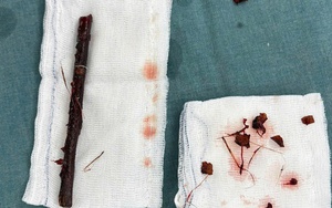 Hy hữu nhành cây dài 16 cm nằm trong bụng bé gái suốt 4 tháng