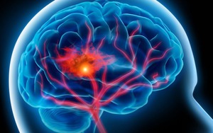 Tập thể dục đều đặn nhưng có thói quen này, đột quỵ vẫn "gõ cửa" lúc nào không hay