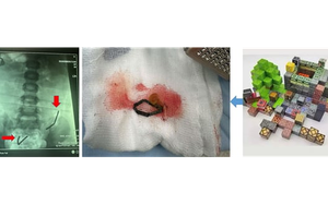 Ớn lạnh phát hiện 20 viên nam châm rỉ sét nằm trong bụng bé trai