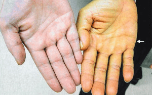 Siêu âm phát hiện nhiều người trẻ gan thô xù xì, nguyên nhân vì đâu?