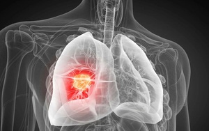 Phát hiện nguyên nhân gây ung thư phổi chưa từng biết