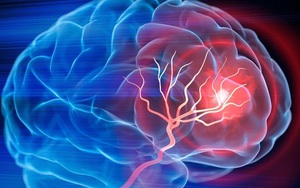 Mỹ phát triển phương pháp trị đột quỵ mới, chỉ cần 1 lần truyền dịch