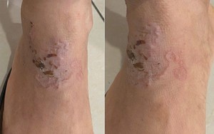 Sinh vật "đào đường hầm" ngoằn ngoèo dưới da người phụ nữ: Bác sĩ chỉ đích danh thủ phạm