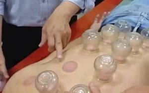 Đột quỵ nặng khi nhờ chị gái giác hơi