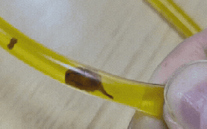 Bác sĩ rùng mình phát hiện thứ đáng sợ trong ống mật của người đàn ông 40 tuổi sau khi bị đau bụng