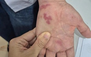 Nguy hiểm: Nhiễm vi khuẩn "ăn thịt người" sau khi bị vây cá đâm