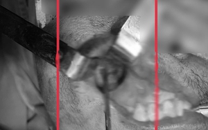 Nấm đen ăn mòn xoang hàm người đàn ông khỏe mạnh