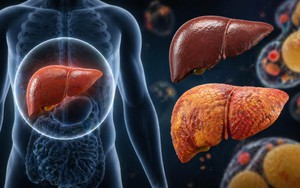 1 loại thực phẩm có thể hại gan hơn cả rượu bia nếu tiêu thụ quá nhiều: Thích đến mấy cũng phải hạn chế