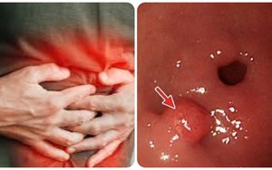 7 dấu hiệu ung thư dạ dày không nên bỏ qua