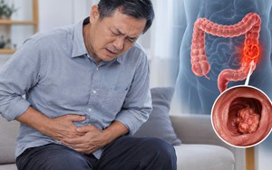 Bác sĩ chỉ: 6 DẤU HIỆU cảnh báo ung thư ruột, nhiều người nhầm tưởng là "rối loạn tiêu hóa"