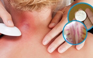 Vì sao đau mỏi người, 'trúng gió' dùng đồ bạc, trứng gà để cạo gió?