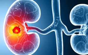 Số ca mắc ung thư thận gia tăng trên toàn cầu: Ở giai đoạn sớm hay muộn đều có 3 dấu hiệu này