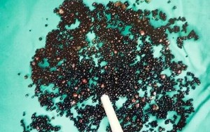 5000 viên sỏi lấp kín túi mật người đàn ông: Bác sĩ nói thẳng: "3 thói quen này là nguyên nhân"