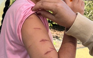 Nữ sinh lớp 5 ở Cà Mau bị người thân dùng dao cắt giấy gây thương tích