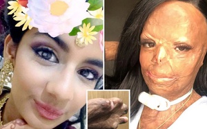 Dầu gội đầu bắt lửa, cô gái bị bỏng nửa người và mất 7 ngón tay