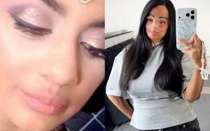 Dầu gội đầu trị chấy bắt lửa, thiếu nữ xinh đẹp bị bỏng nửa người và mất 7 ngón tay