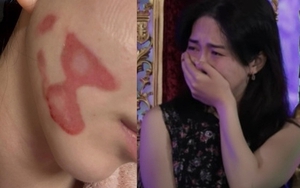 Nữ thần sắc đẹp showbiz bị bỏng mặt nghiêm trọng hậu thẩm mỹ, nhìn tình hình hiện tại mà xót thay