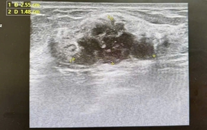 Phát hiện ung thư khi đi khám sức khoẻ định kỳ