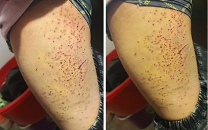 Nữ sinh lớp 7 dùng bút bi đâm hơn 20 lần vào đùi bạn học: Đây là nguyên nhân