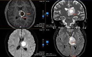 Thường xuyên buồn ngủ, đi khám “sốc” nặng khi biết nguyên nhân