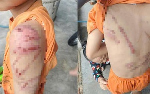 Lý do người cha đánh con 10 tuổi bầm tím khắp người