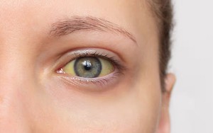 Cảnh báo 4 dấu hiệu của loại ung thư "sát thủ thầm lặng": Nếu có phải đi khám ngay