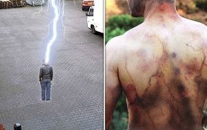 Người đàn ông sống sót sau 4 lần bị sét đánh, kể lại điều thực sự xảy ra với cơ thể mình