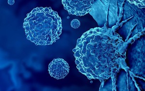 Loại ung thư đứng thứ 2 về tỉ lệ tử vong tại Việt Nam: 5 dấu hiệu sớm nhất ai cũng nên biết