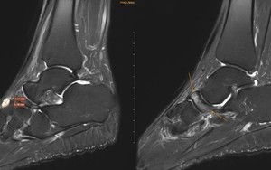 4 thói quen âm thầm “ăn mòn” xương ở người trên 40 tuổi