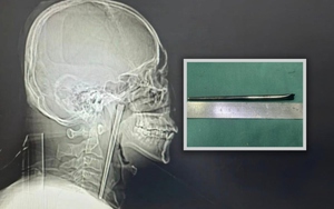 Người đàn ông sống 8 năm với chiếc đũa trong cổ họng và cái kết khiến cộng đồng mạng không thể tin nổi