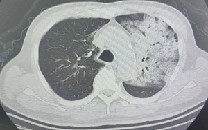 Người đàn ông sốt 40 độ C, phổi gần như 'trắng xóa", chỉ vài ngày đã suy đa tạng: Thủ phạm liên quan đến thói quen nhiều gia đình vẫn mắc
