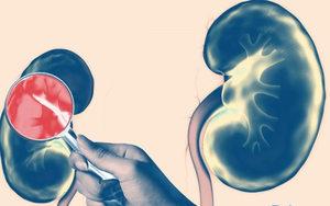 Bàng hoàng phát hiện suy thận sau khi có 1 dấu hiệu tưởng không liên quan