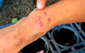 Thái Lan bật cảnh báo khi 23 người tử vong, 732 người bị lây nhiễm 1 căn bệnh, ở Việt Nam cũng đã xuất hiện