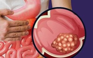 Phát hiện ung thư giai đoạn 4 ở tuổi 26, nam thanh niên hối hận: Giá như tôi không bỏ qua triệu chứng này