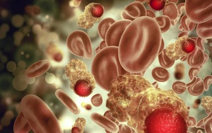 Nghiên cứu 25 năm chỉ ra 2 dấu hiệu nguy hiểm của ung thư máu