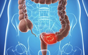 Người đàn ông 45 tuổi tử vong sau vài tháng phát hiện ung thư đại trực tràng: “Thủ phạm” là 3 ĐIỀU người Việt nào cũng hiểu nhưng LƯỜI LÀM