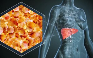 1 bệnh về gan “bùng lên”, người trẻ cũng không còn an toàn: Bác sĩ chỉ ra xu hướng điều trị mới